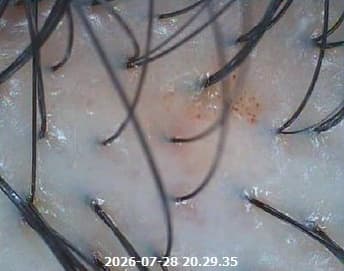 사용 후 두피 관찰 이미지 - 건조 각질 정돈