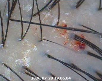 사용 전 두피 관찰 이미지 - 건조 각질 들뜸